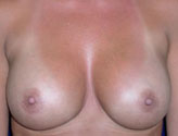 Patient # 89338 After Photo # 2
